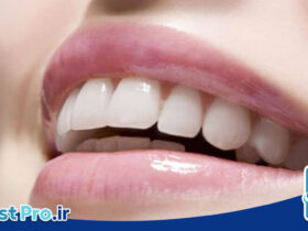 راهنمای کامل لمینت دندان برای مبتدی ها