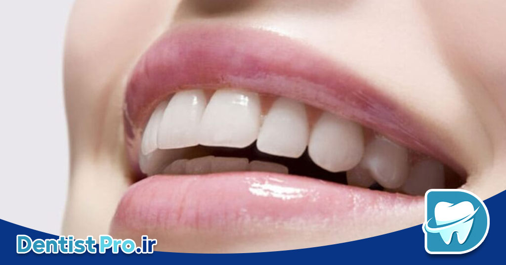 بهترین نوع لمینت برای دندان های حساس: راهنمای جامع و تخصصی