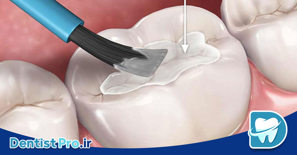 بهترین روش برای درمان دندان پوسیده 29 بهترین روش برای درمان دندان پوسیده