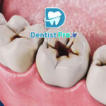 بهترین روش برای درمان دندان پوسیده