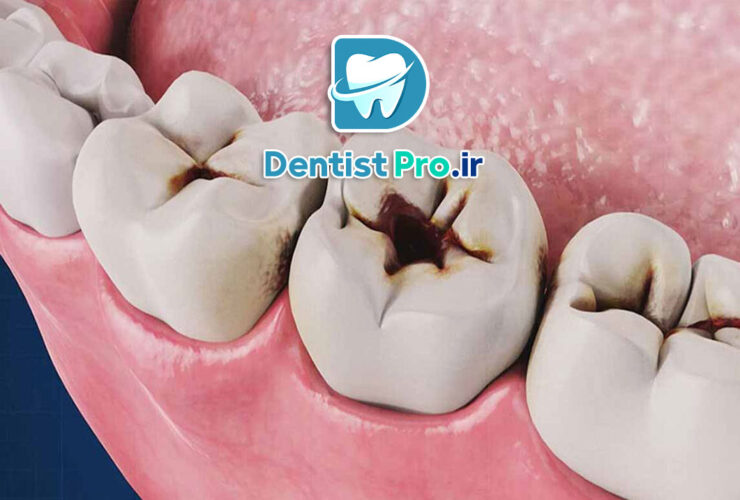 بهترین روش برای درمان دندان پوسیده