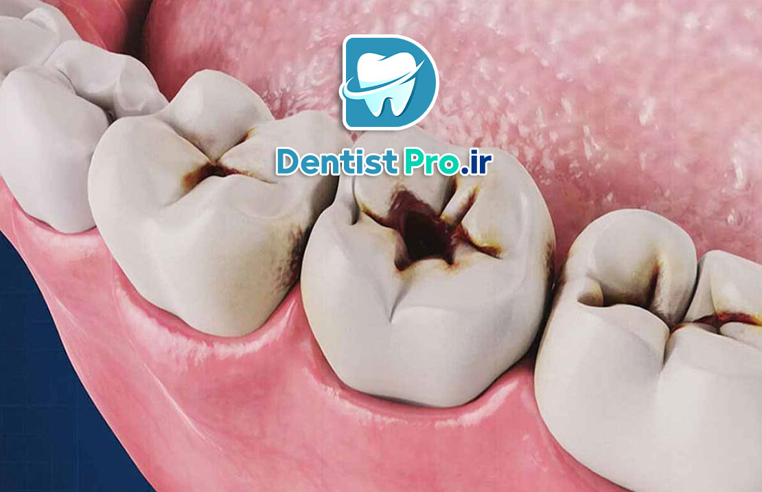 بهترین روش برای درمان دندان پوسیده 25 بهترین روش برای درمان دندان پوسیده