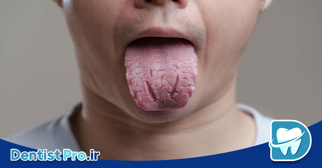 چرا زبان ترک خورده می شود؟