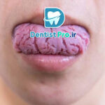 چرا زبان ترک خورده می شود؟