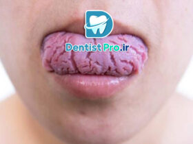 چرا زبان ترک خورده می شود؟