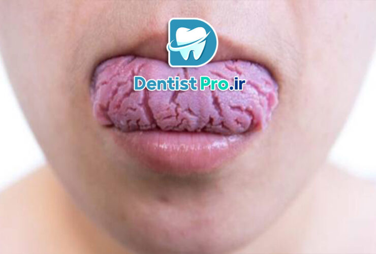 چرا زبان ترک خورده می شود؟