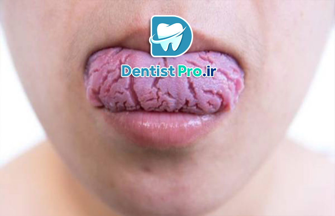 چرا زبان ترک خورده می شود؟