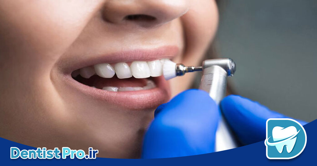 تفاوت بلیچینگ با جرم گیری؛ بررسی کامل روشهای سفید کردن دندان 27 تفاوت بلیچینگ با جرم گیری؛ بررسی کامل روشهای سفید کردن دندان