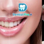 تفاوت بلیچینگ با جرم گیری؛ بررسی کامل روش‌های سفید کردن دندان