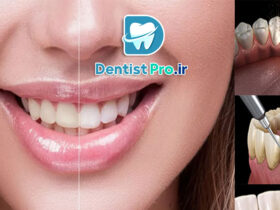 تفاوت بلیچینگ با جرم گیری؛ بررسی کامل روش‌های سفید کردن دندان