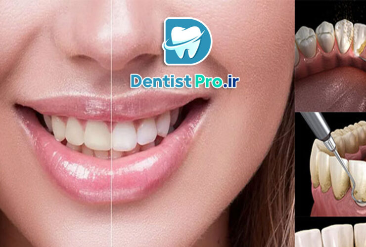 تفاوت بلیچینگ با جرم گیری؛ بررسی کامل روشهای سفید کردن دندان 41 تفاوت بلیچینگ با جرم گیری؛ بررسی کامل روشهای سفید کردن دندان