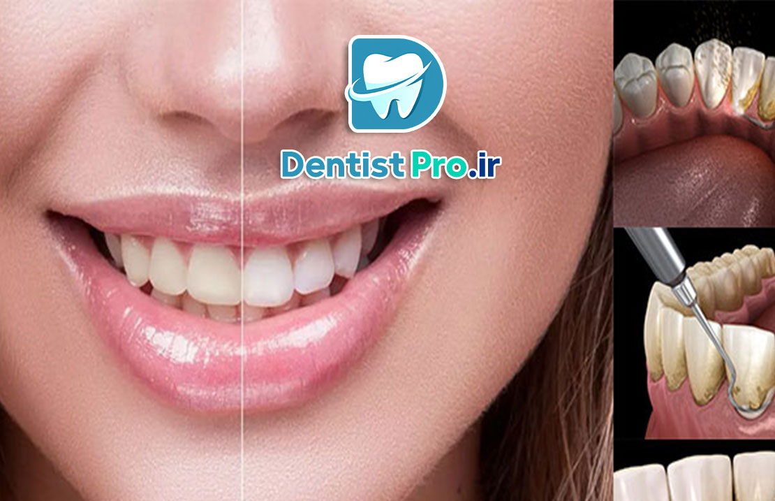 تفاوت بلیچینگ با جرم گیری؛ بررسی کامل روشهای سفید کردن دندان 25 تفاوت بلیچینگ با جرم گیری؛ بررسی کامل روشهای سفید کردن دندان