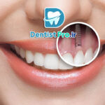 تفاوت ایمپلنت خارجی و ایرانی؛ بررسی کامل کیفیت، قیمت و ماندگاری