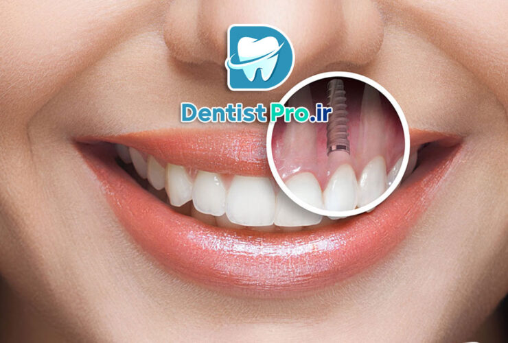 تفاوت ایمپلنت خارجی و ایرانی؛ بررسی کامل کیفیت، قیمت و ماندگاری 34 تفاوت ایمپلنت خارجی و ایرانی؛ بررسی کامل کیفیت، قیمت و ماندگاری