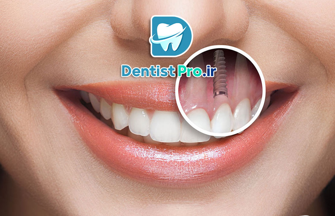 تفاوت ایمپلنت خارجی و ایرانی؛ بررسی کامل کیفیت، قیمت و ماندگاری 25 تفاوت ایمپلنت خارجی و ایرانی؛ بررسی کامل کیفیت، قیمت و ماندگاری