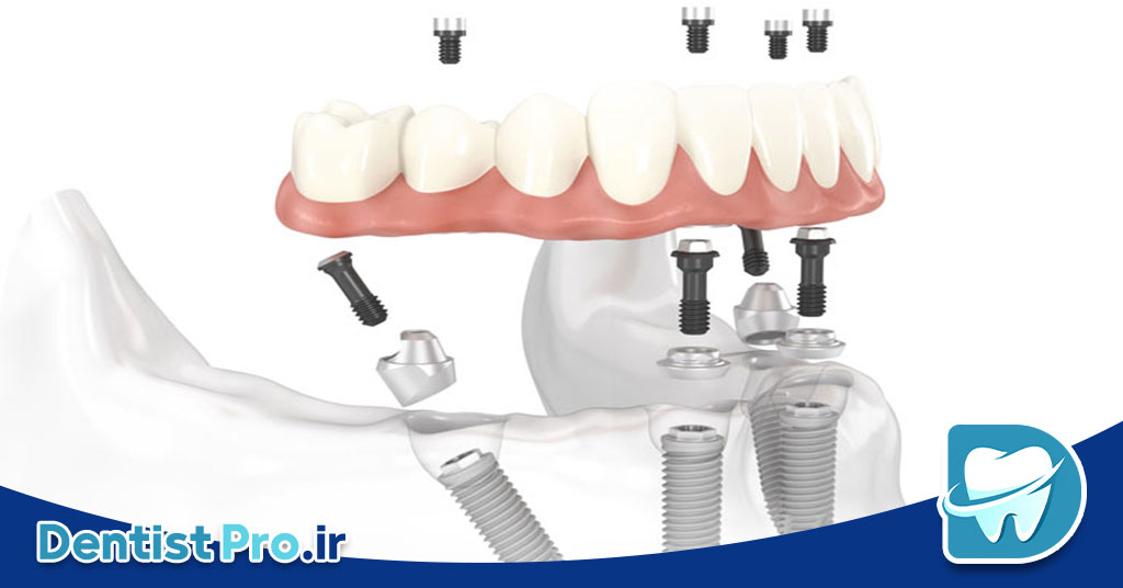 تفاوت ایمپلنت خارجی و ایرانی؛ بررسی کامل کیفیت، قیمت و ماندگاری 28 تفاوت ایمپلنت خارجی و ایرانی؛ بررسی کامل کیفیت، قیمت و ماندگاری