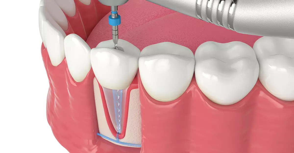 معرفی انواع فایل های روتاری در دندانپزشکی 28 معرفی انواع فایل های روتاری در دندانپزشکی
