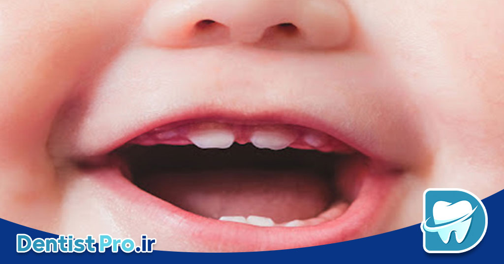 تاثیر شیر شب بر دندان کودک 28 تاثیر شیر شب بر دندان کودک