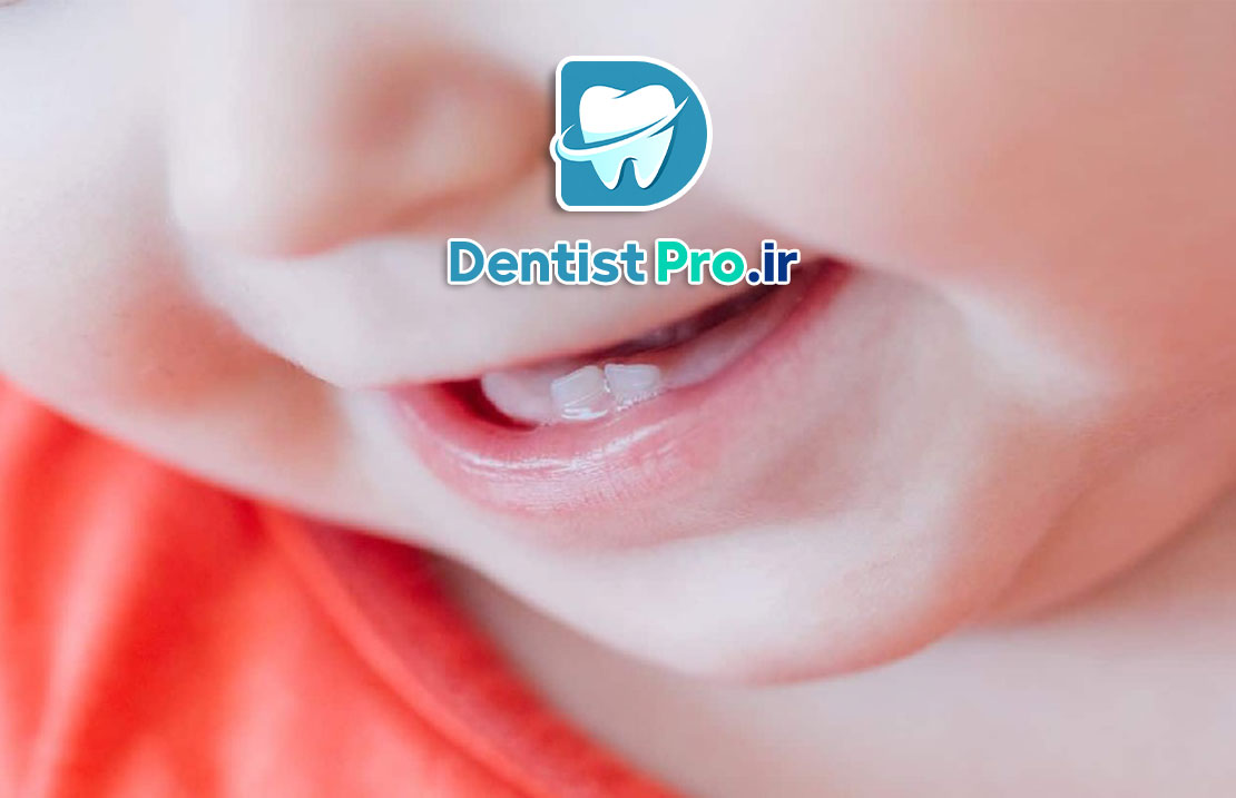 تاثیر شیر شب بر دندان کودک 25 تاثیر شیر شب بر دندان کودک