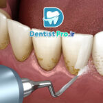 جرم لثه؛ پیشگیری، علائم و راه‌های درمان