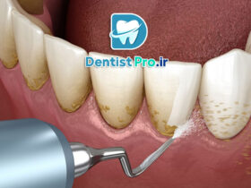جرم لثه؛ پیشگیری، علائم و راه‌های درمان