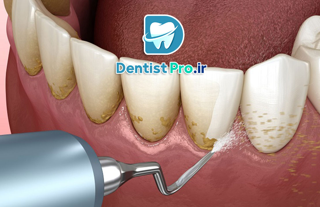 جرم لثه؛ پیشگیری، علائم و راه‌های درمان