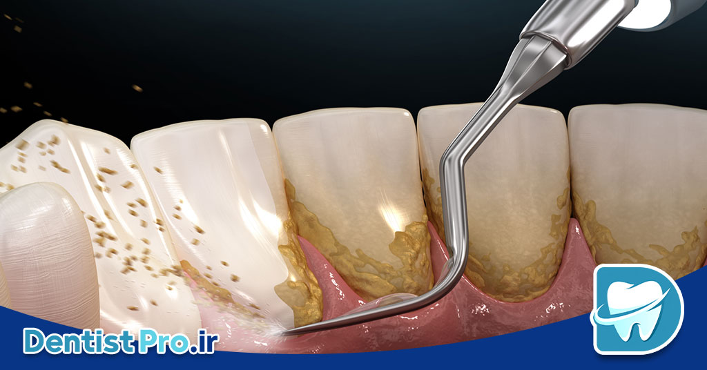 جرم لثه؛ پیشگیری، علائم و راه‌های درمان