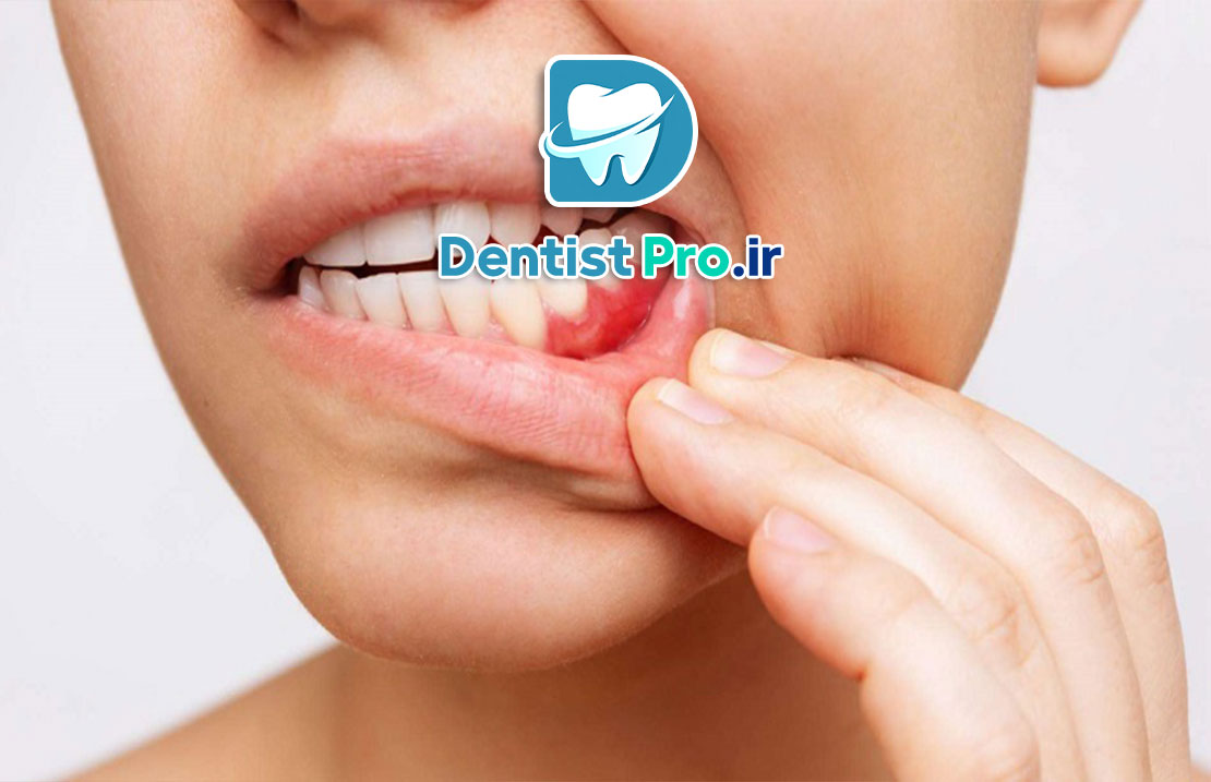 لثه دردناک؛ علل، درمان‌ها و راهکارهای پیشگیری