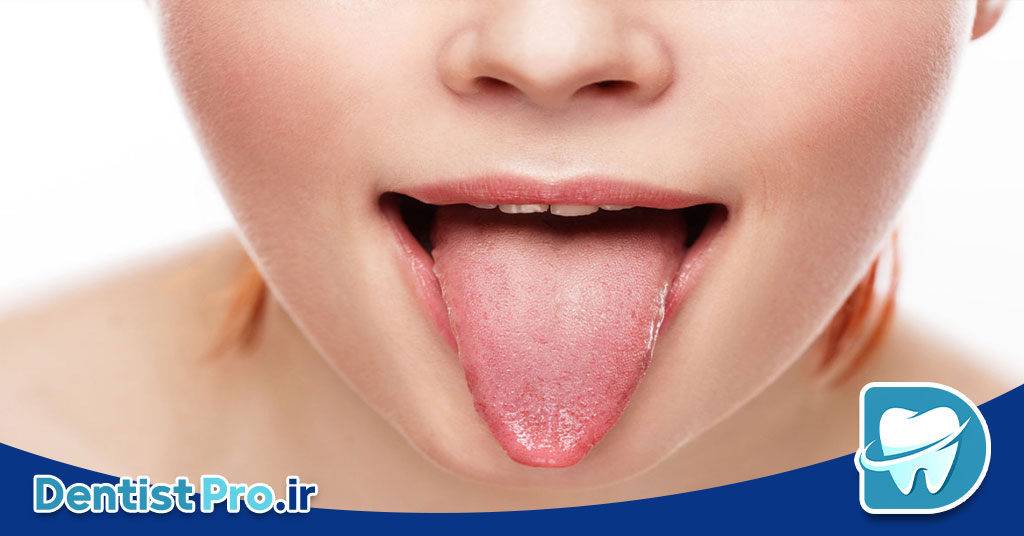 رابطه زبان با سلامت دهان و دندان 27 رابطه زبان با سلامت دهان و دندان