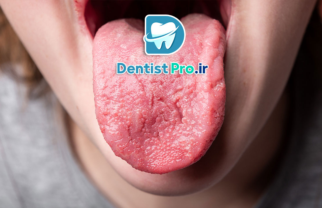 درد زبان: علل، علائم، تشخیص و راههای درمان 25 درد زبان: علل، علائم، تشخیص و راههای درمان