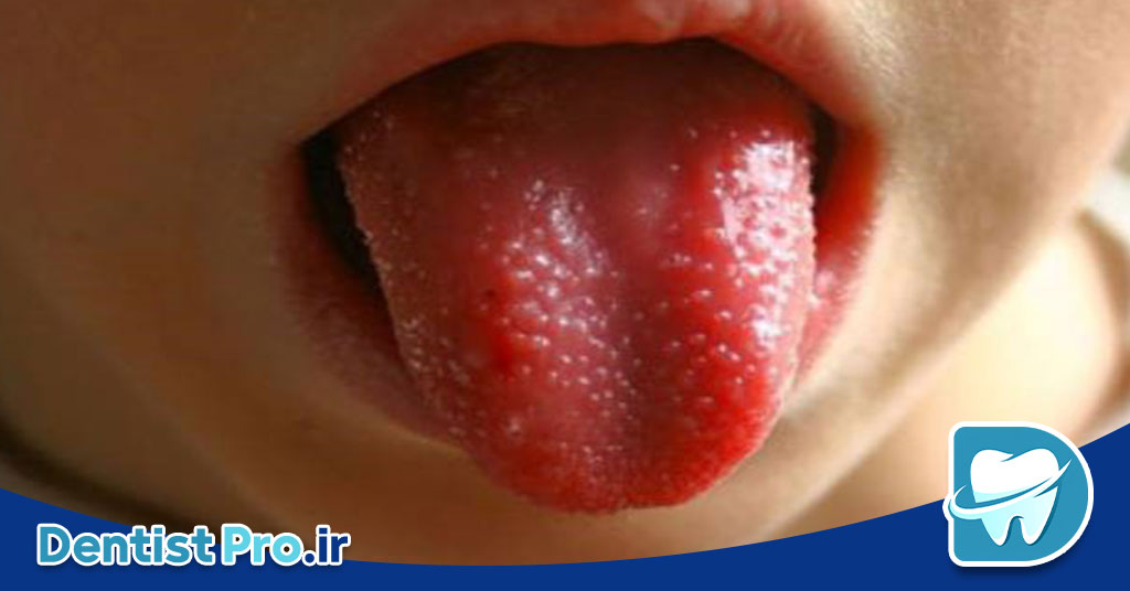 درد زبان: علل، علائم، تشخیص و راههای درمان 28 درد زبان: علل، علائم، تشخیص و راههای درمان