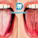 علل سفید شدن زبان چیست؟