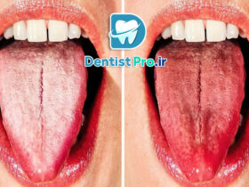 علل سفید شدن زبان چیست؟