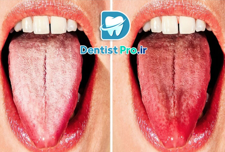 علل سفید شدن زبان چیست؟