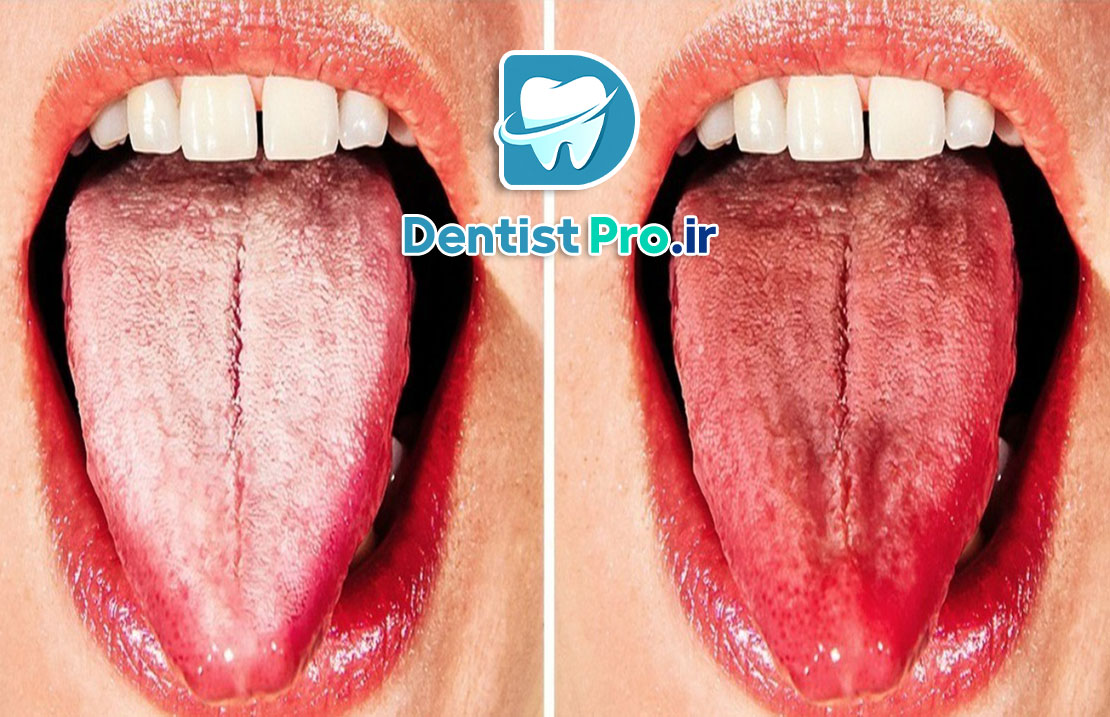 علل سفید شدن زبان چیست؟ 25 علل سفید شدن زبان چیست؟