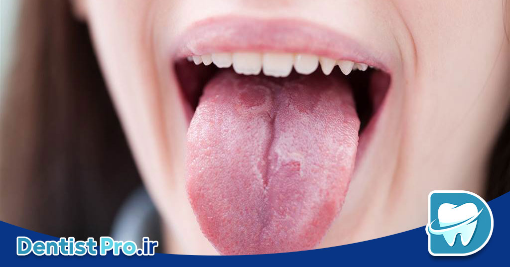 علل سفید شدن زبان چیست؟ 28 علل سفید شدن زبان چیست؟