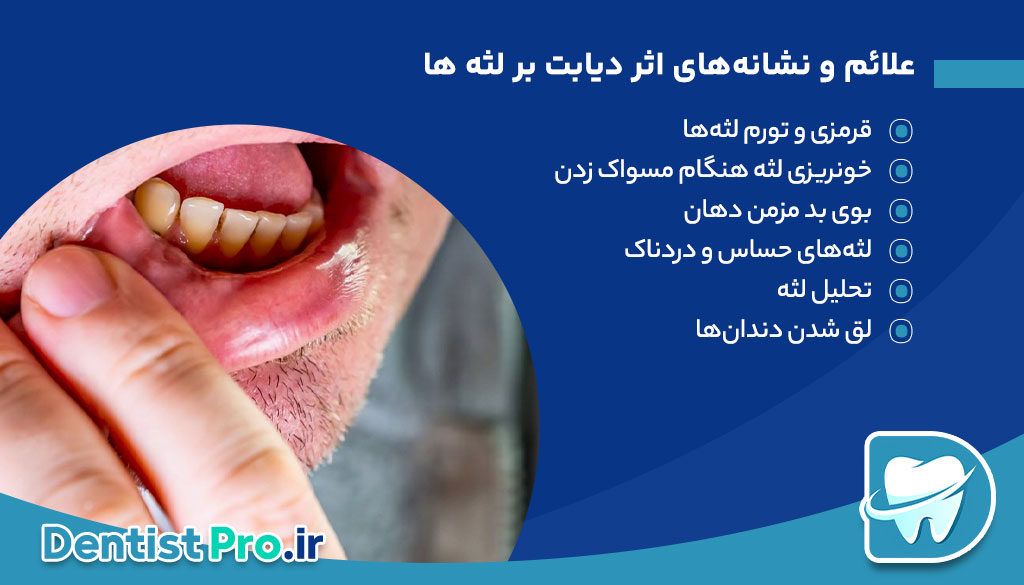 اثر دیابت بر لثه ها: چگونه دیابت سلامت لثه‌ها را تحت تأثیر قرار می‌دهد؟