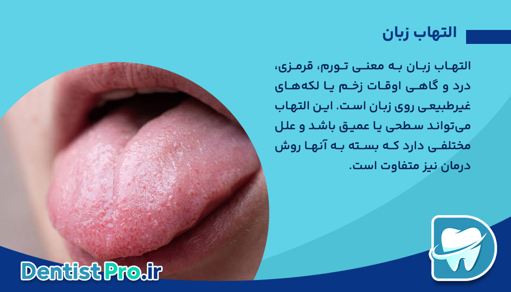 التهاب زبان+ بیماری که باید آن را بشناسید 26 التهاب زبان+ بیماری که باید آن را بشناسید