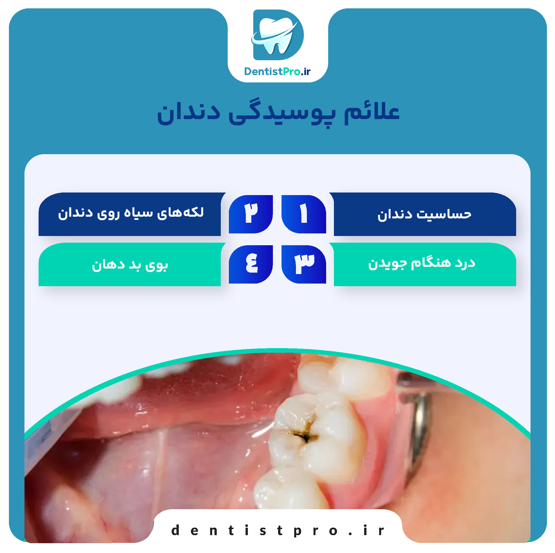 بهترین روش برای درمان دندان پوسیده 26 بهترین روش برای درمان دندان پوسیده