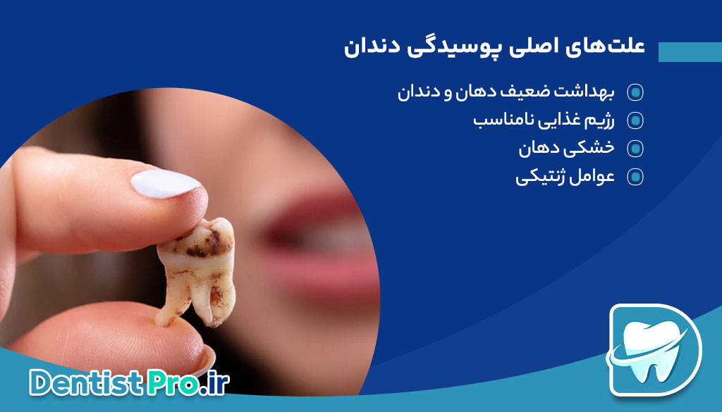 بهترین روش برای درمان دندان پوسیده 27 بهترین روش برای درمان دندان پوسیده