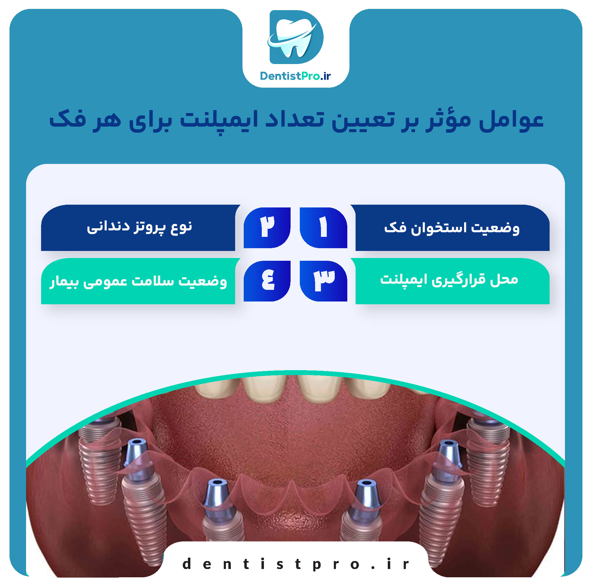 تعداد ایمپلنت برای هر فک چقدر است؟