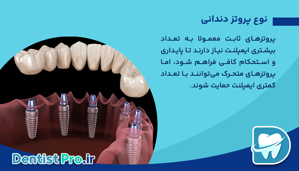 تعداد ایمپلنت برای هر فک چقدر است؟