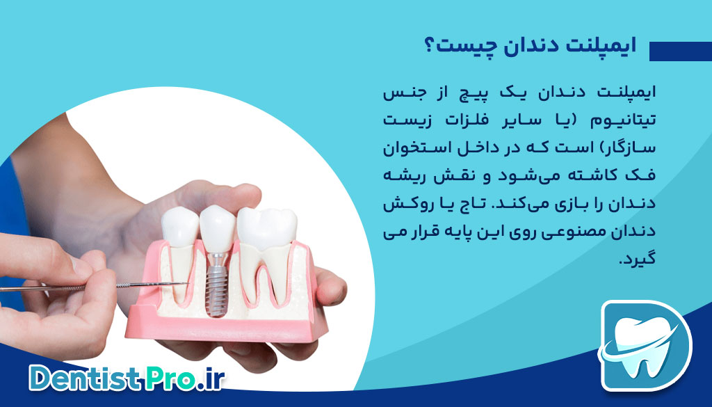 تعویض ایمپلنت دندان؛ دلایل، مراحل و نکات مهم 26 تعویض ایمپلنت دندان؛ دلایل، مراحل و نکات مهم