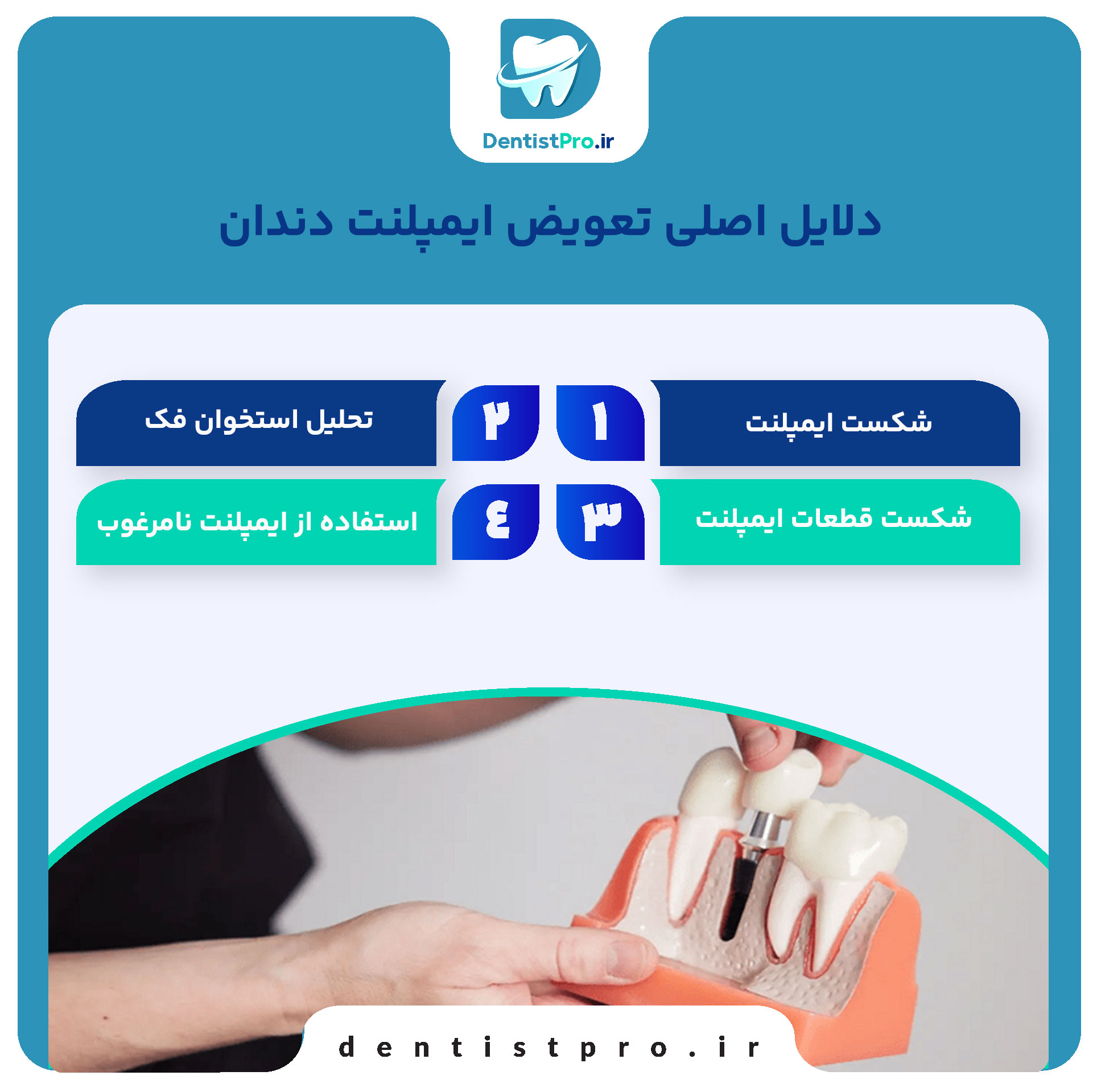 تعویض ایمپلنت دندان؛ دلایل، مراحل و نکات مهم 27 تعویض ایمپلنت دندان؛ دلایل، مراحل و نکات مهم