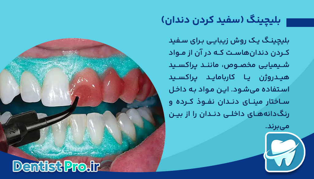 تفاوت بلیچینگ با جرم گیری؛ بررسی کامل روشهای سفید کردن دندان 26 تفاوت بلیچینگ با جرم گیری؛ بررسی کامل روشهای سفید کردن دندان