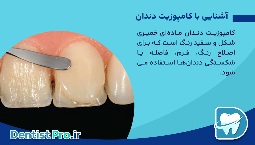 تفاوت کامپوزیت دندان ایرانی و خارجی: بررسی تخصصی کیفیت، قیمت و ماندگاری