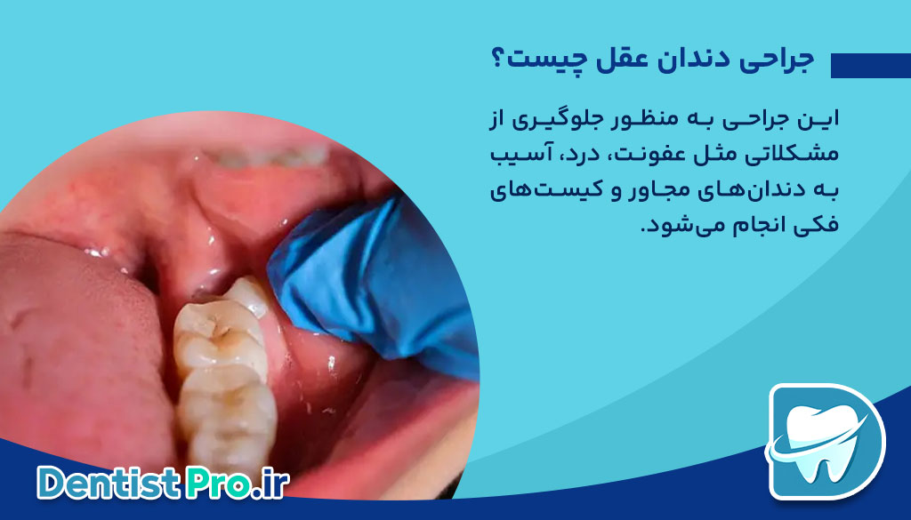 جراحی دندان عقل با بی حسی موضعی؛ راهنمای کامل و کاربردی