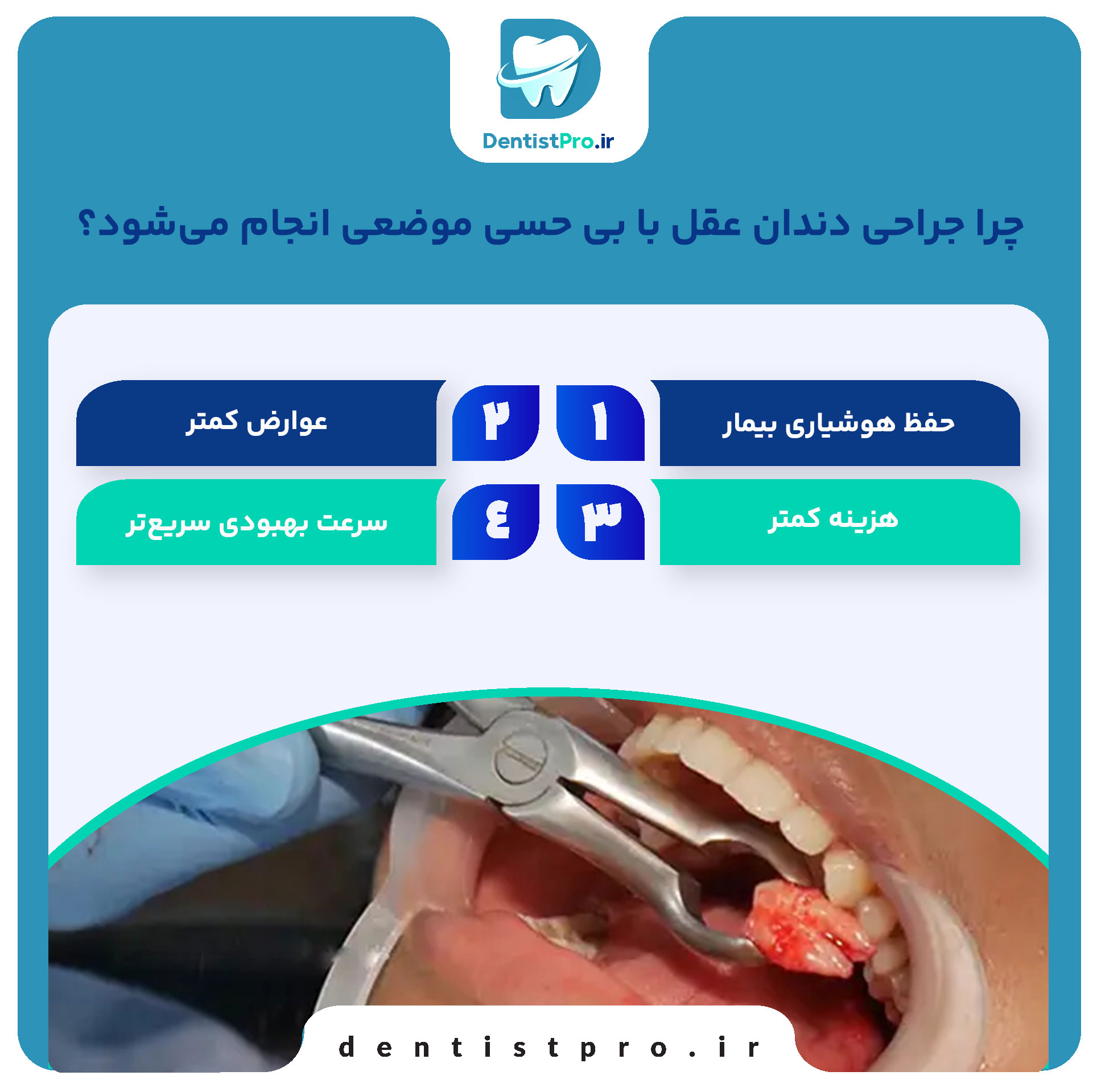 جراحی دندان عقل با بی حسی موضعی؛ راهنمای کامل و کاربردی