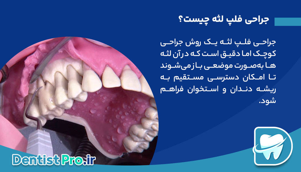 جراحی فلپ لثه: راهکاری تخصصی برای درمان بیماریهای پیشرفته لثه 26 جراحی فلپ لثه: راهکاری تخصصی برای درمان بیماریهای پیشرفته لثه