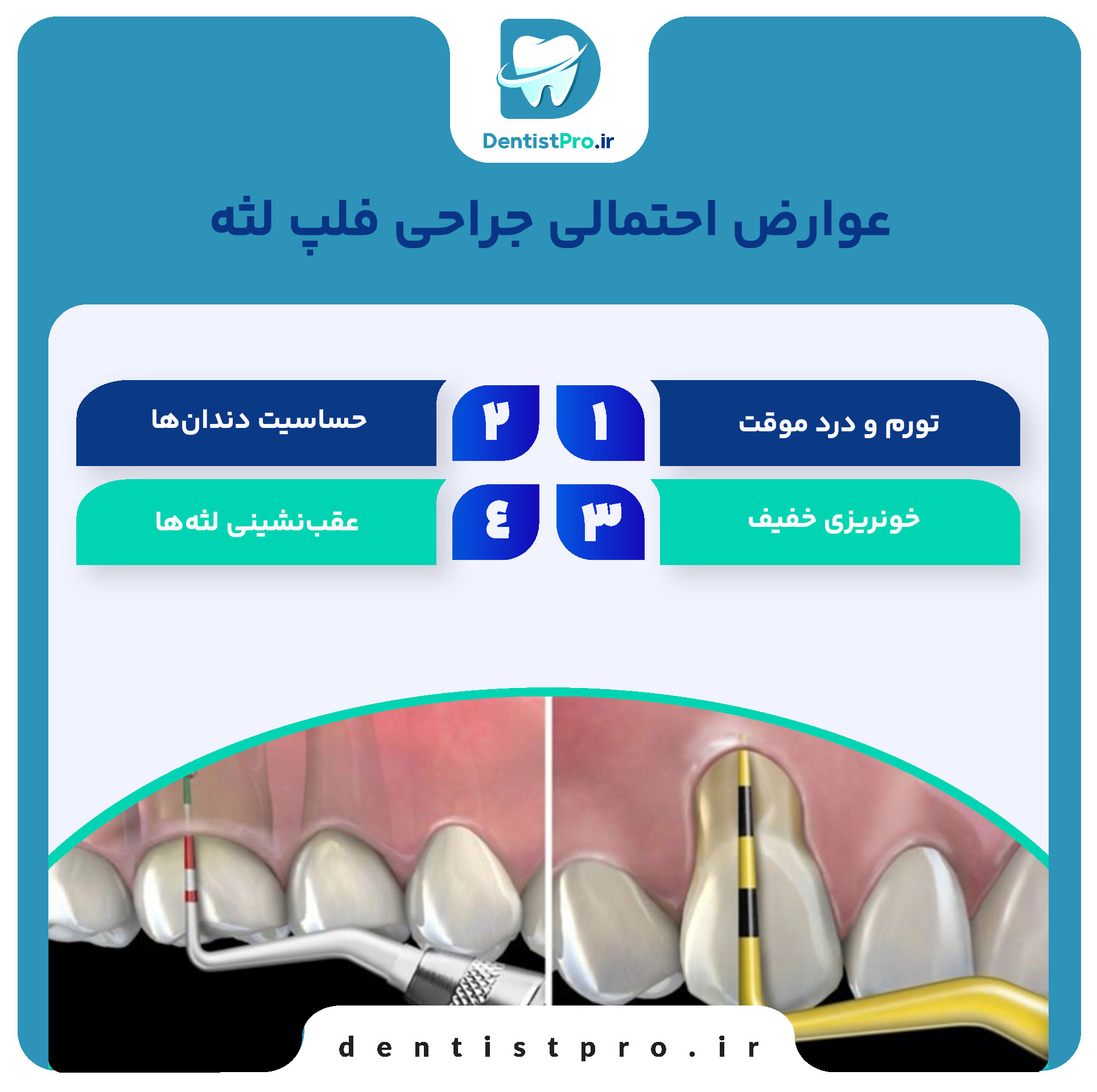 جراحی فلپ لثه: راهکاری تخصصی برای درمان بیماریهای پیشرفته لثه 29 جراحی فلپ لثه: راهکاری تخصصی برای درمان بیماریهای پیشرفته لثه